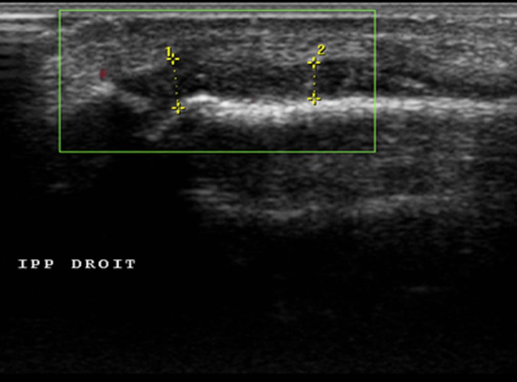 Fig. 19: Inactive synovitis of the proximal
