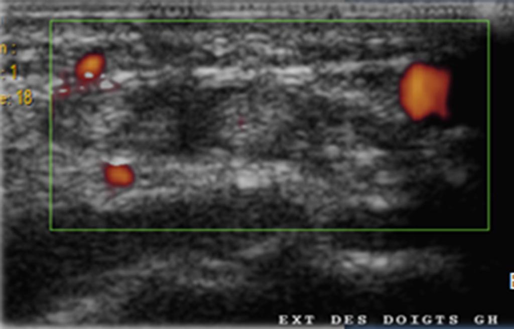 Fig. 23: Axial section showed the tenosynovitis of the extensor digitorum Fig.