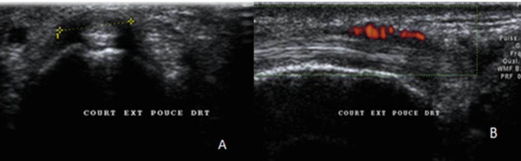 normal aspect of abductor pollicis longus and Longtitudinal (B) ultrasound shows