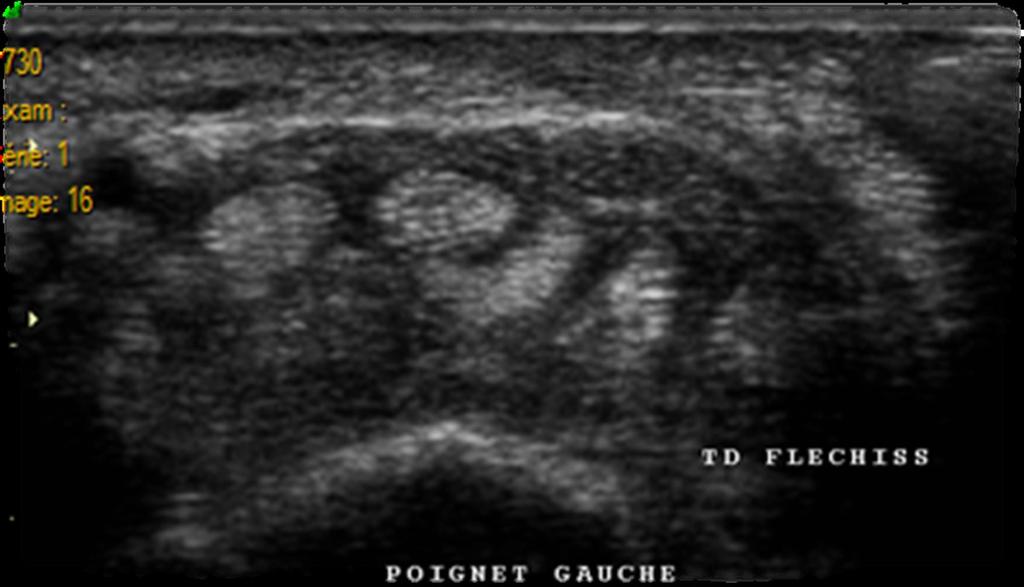 Images for this section: Fig. 1: Normal sonographic appearances of the carpal tunnel.