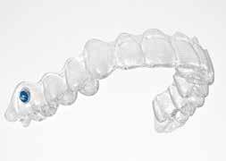 Class II Correction with Clear Aligner Systems. The Carriere Motion Appliance may be used with patients who want to be treated with clear aligners, but display a Class II malocclusion.