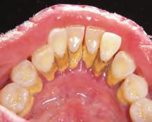 Plaque that is not removed between the teeth and on the gum line can cause the gums to become red, puffy, and swollen. Image Elsevier Inc. All rights reserved.