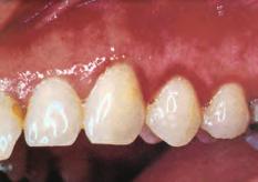 p Gingivitis The bacteria in plaque make your gums red, tender and swollen. Your gums might bleed at this stage.