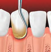 Scaling and Root Planing Scaling removes plaque and tartar from below the gumline. Root planing smoothes the tooth root and helps the gums reattach to the tooth.