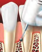 Periodontal Surgery If the pockets do not heal enough after scaling and root planing, periodontal surgery may be needed.