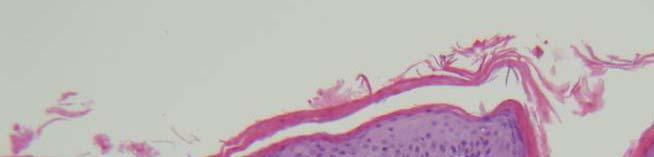 Histology: Pityriasis rubra pilaris Biopsy @ site