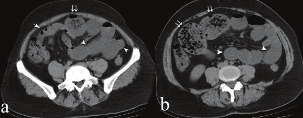 (arrow heads). complaints, all of which were ongoing for one month and no history of previous abdominal surgeries. Abdominal CT eter: 5.3 cm) with a normal diameter of the distal segments.