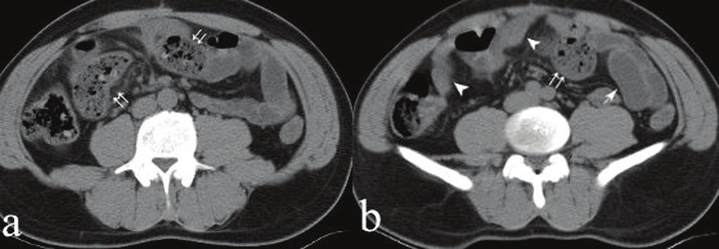 b) SBF extending to the level of the terminal ileum (double arrow). intestine. The patient died on the 15th day following, before further investigations could be performed.