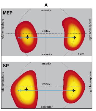 SILENT PERIOD AFTER MOTOR POTENTIAL EVOKED BY TMS IN STROKE PATIENTS Topographic MEP
