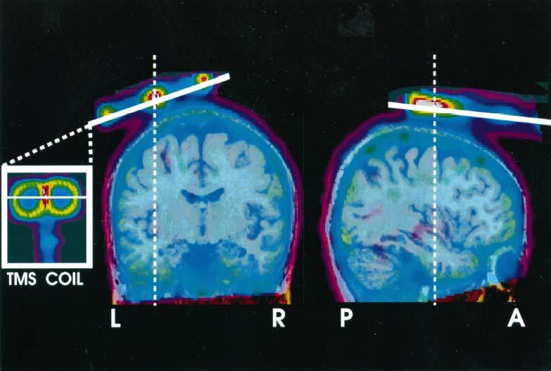 MRI LOCALIZATION AIDED TMS 9/14/2011.