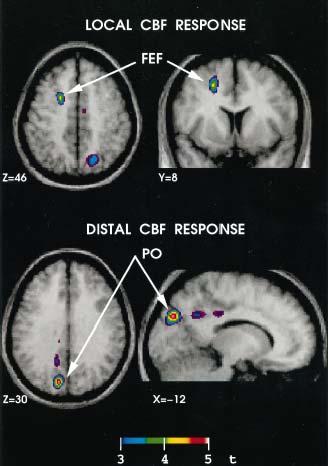 TMS-EVOKED DISTAL CBF RESPONSE (PET) Magnetic stimulation of the frontal eye field (FEF) induces local cerebral