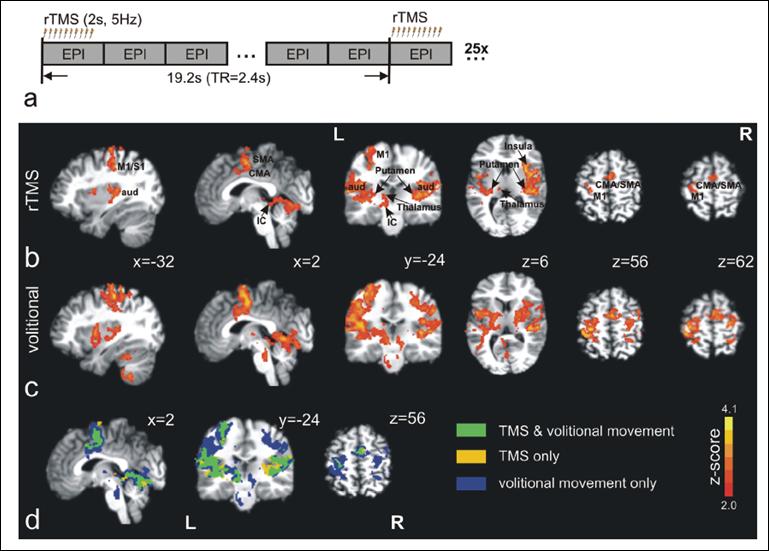 fmri RESPONSE OF VOLITIONAL AND TMS- EVOKED HAND MOVEMENT IS SIMILAR http://www.
