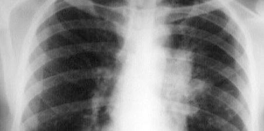 Pathogenesis of Pulmonary Acquired Tuberculosis Primary Disease