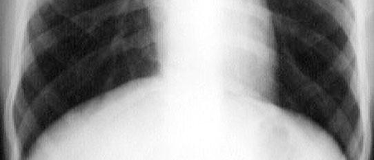 of lung Pneumonia Multiplication With poor CMI Pleurisy