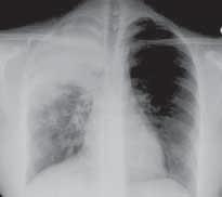 Diagnosing Pneumonia Your healthcare provider will take a detailed health history and perform a physical exam. You will also have some tests.