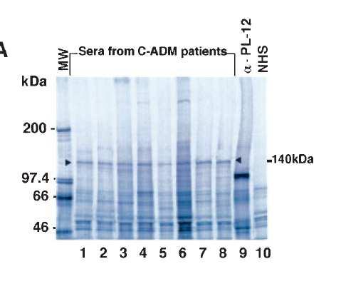 Anti-CADM-140 (MDA5) autoantibody First described in Japan (19-35% DM and 53-73% CADM), recently US 10 patients with DM