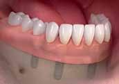 Your Fixed Denture Options