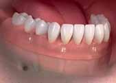 Removable Denture Options Removable