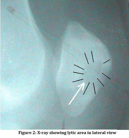 Tuberculosis of Patella- A case report. Indian journal of Orthopaedics 2004.