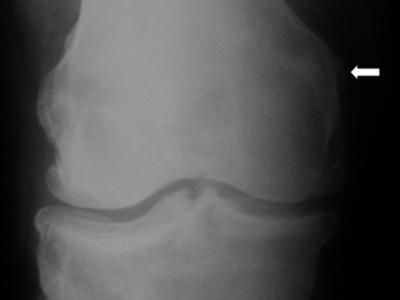 proximal aspect of the MCL (arrow).