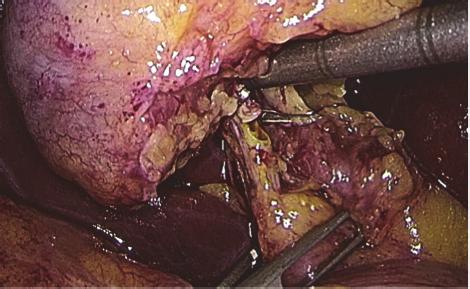 and fluid. When bile clearance is satisfactory, two metallic clips are placed to close proximally the cystic duct (Figure 6).