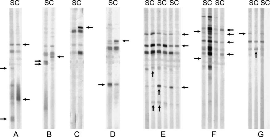 1634 Comparative immunoblot in neuroborreliosis Fig. 1. Different patterns of intrathecal antibody production by comparative immunoblot in patients with NB (S ¼ serum, C ¼ CSF).