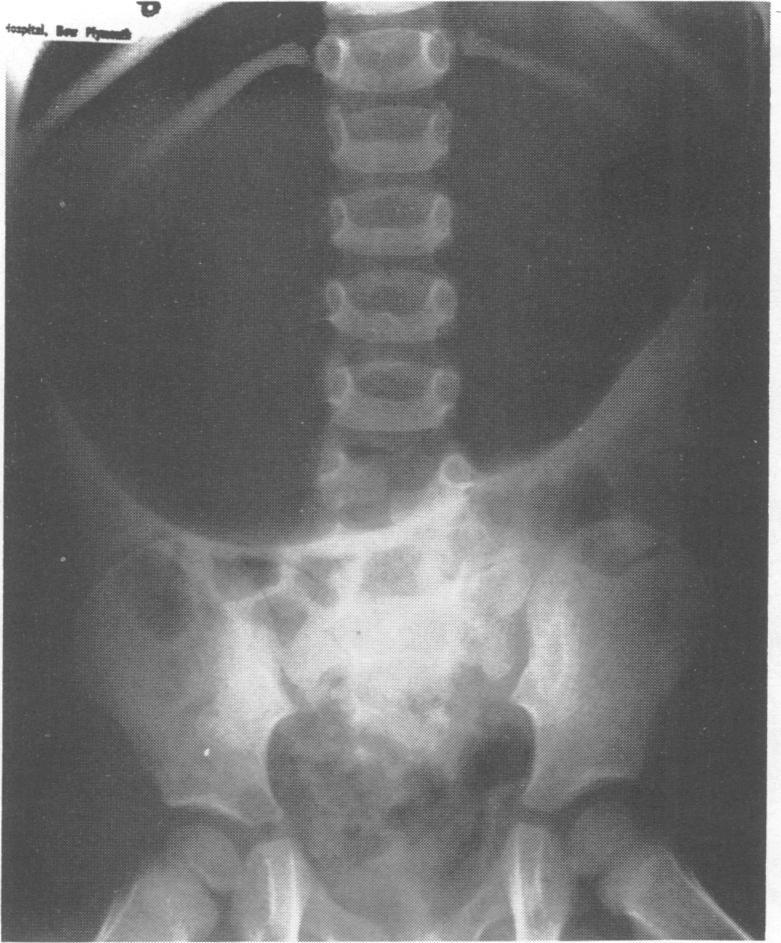 Miller syndrome Figure le Abdominal x ray showing gastric dilatation owing to torsion. stomach, not attached to the diaphragm.