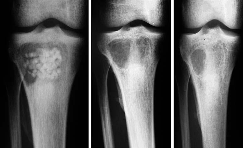 ADULT OSTEOMYELITIS 241 Fig. 2. AP-views of right tibia : 1, 3 and 6 months after debridement and implantation of Osteoset T. Note early resorption of Osteoset T and only partial ingrowth of bone.