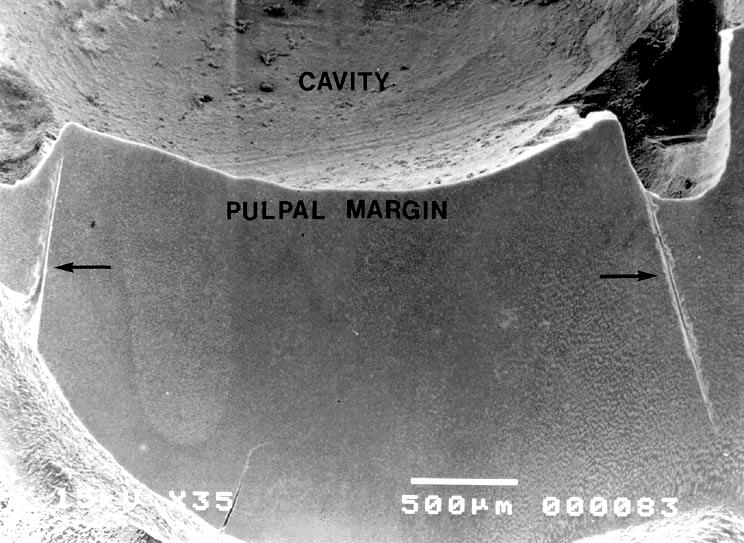 1 3 Fig. 1. Marks (arrows) were made at both ends of pulpal margin as a reference for nanohardness indentation on caries-affected dentin (x35). Fig. 3. Indentation marks on intertubular dentin, T = dentinal tubule.
