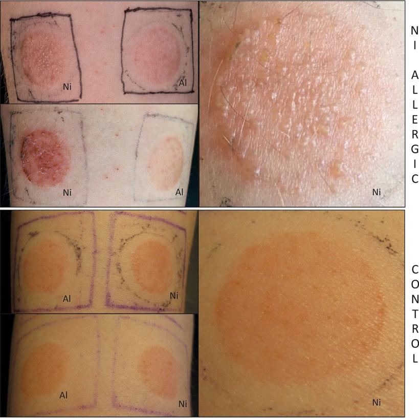 Short contact with nickel causes allergic contact dermatitis, M.G. Ahlstr om et al.
