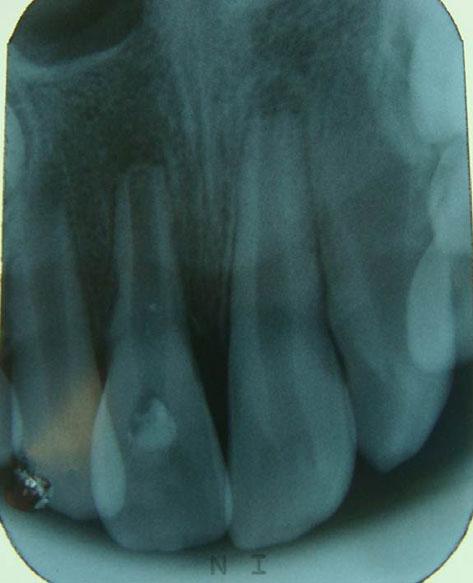 V Chacko and M Pradhan sulcus in relation to the intruded central incisor and the tooth showed Grade 1 mobility.