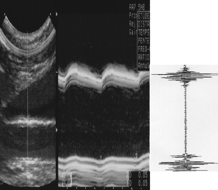 volume Common carotid artery IMT, diameter and stiffness : Walltrack system 150 Pressure (mmhg) 125 100 D V 7.
