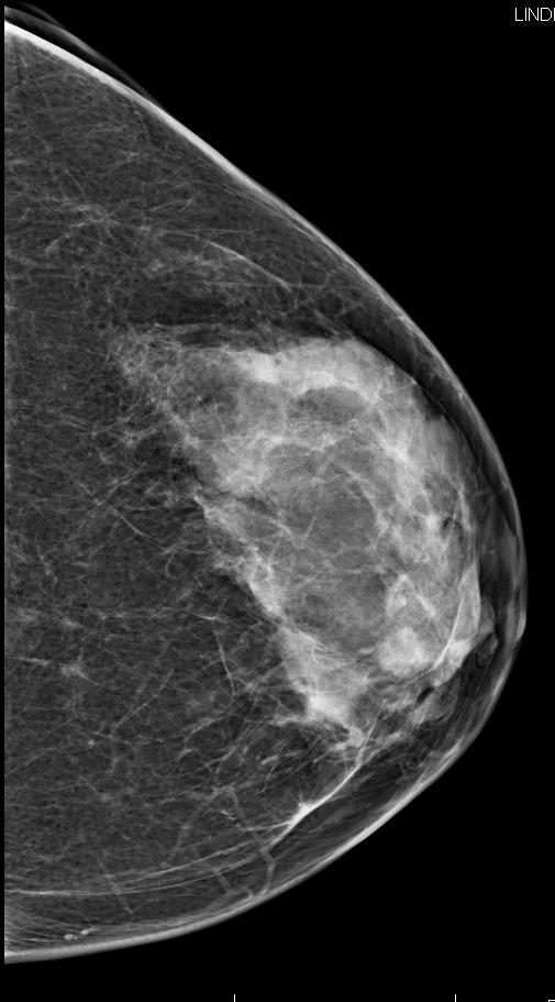 Figure 1 Mammography of the left breast