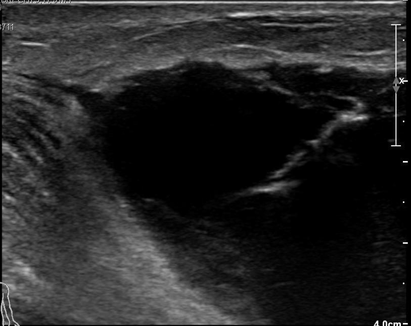 Figure 2 Ultrasonography of the left breast