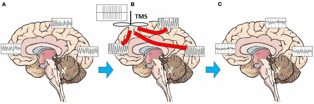 Other Theory of TMS Mechanism of Action MDD is marked by disturbances in brain functional connectivity, thalamocortical dysrhythmia.