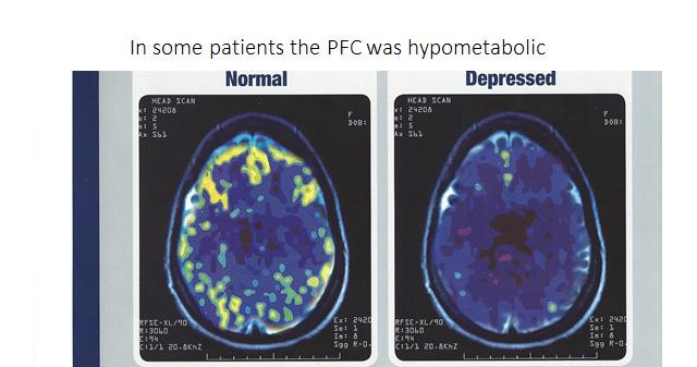 Major Depression is a Brain Disease PFC = prefrontal cortex. Mark S. George, MD.