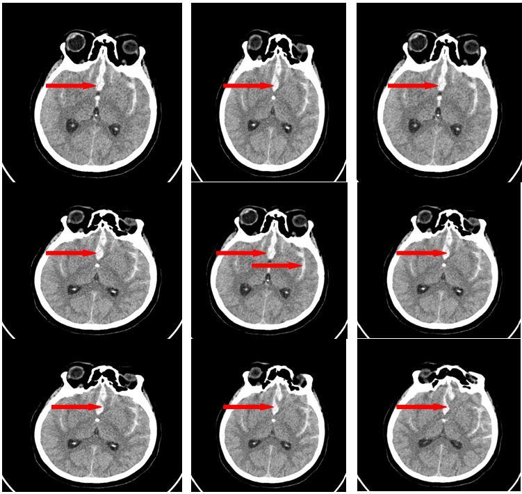 In the patients with SAH at the development of clinical manifestation of SI on the background of CAS the formation of secondary ischemia zone was pointed by the control MSCT of the brain (Fig.6, 7).