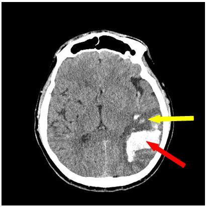 The volume of ischemia nidus can exceed the volume of intracerebral hematoma in several times and can lead to the median structures dislocation causing different types of impaction (Fig.-10).