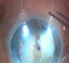 Endoillumination assisted cataract surgery in eyes with corneal opacities is useful for avoiding keratoplasty in patients with minimal to moderate corneal opacities who can be visually