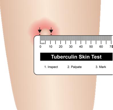 Testing Methodologies for Immune Response Tuberculin skin testing (TST) Interferongamma release assay (IGRA) Mantoux test, Purified Protein Derivative (PPD) T-SPOT.