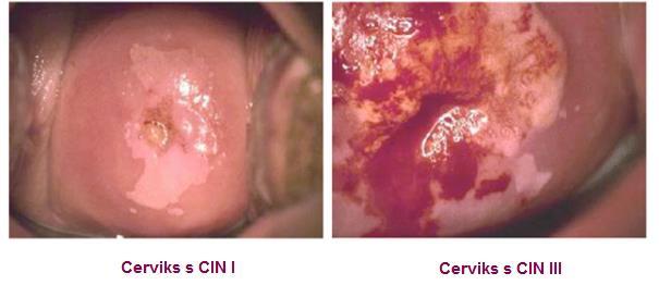 Slika 16: Invazivni karcinom (Sellors i Sankaranarayanan, 2003) Slika 17: (CIN) na površini cerviksa (gledano kolposkopom) (www.asccp.