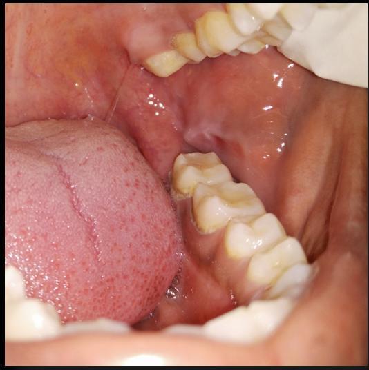 greatest dimension extending inferiorly upto 1mm above the inferior border of mandible and involving the distal aspect of the radicular portion of 37.