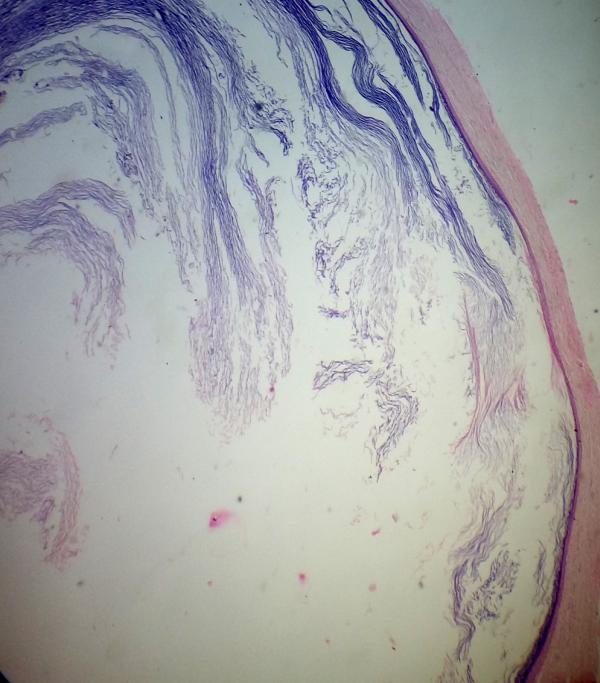 Gross picture of the excised specimen showing presence of a cyst attached to the apical 3 rd of tooth root.