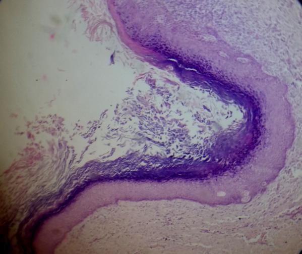 cells having palisading arrangement of nuclei. The epithelialconnective tissue interface was rather flat and devoid of rete ridges.