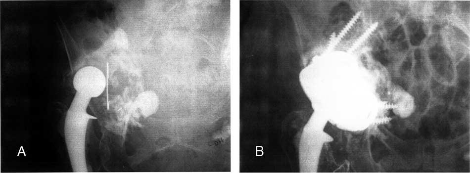 The Treatment of Pelvic Discontinuity During Acetabular Revision! Sporer et al 83 Fig. 4. A 62-year-old man with (A) failed cemented component and a type IIIB acetabular defect.