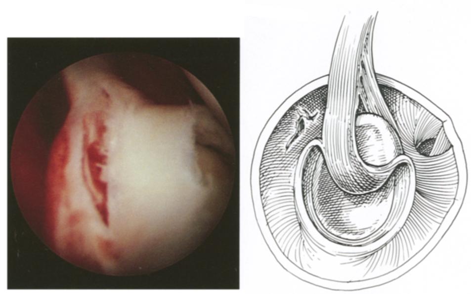 SLAP LESIONS 277 OF THE SHOULDER 3A,B PIG. 3. Arthroscopic (A) and schematic (B) illustration of III SLAP lesion.
