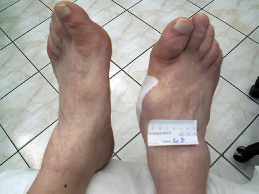 In patients suffering from diabetes since childhood, these changes may develop as early as in the third or fourth decade of life. Fig. 1. Patient with diabetic foot syndrome.