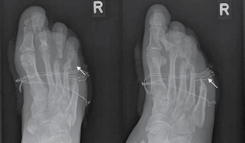 Radiographs in the dorsiplantar and oblique views. Significant soft tissue edema of the 1 st toe. Osteolysis of the distal phalanx of the first ray.