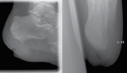 distribution of weight-bearing forces and increased risk of ulceration with serious consequences. In this situation, the patient may require surgical intervention to correct the deformity.