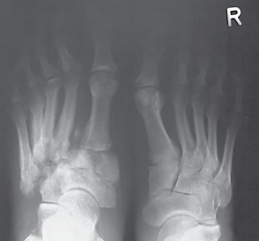 Bone destruction and numerous dislocations within the tarsal bones in the course of Charcot arthropathy Fig. 9. Radiographs in dorsiplantar and oblique views.